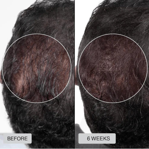 Red Light Cap for Hair Regrowth