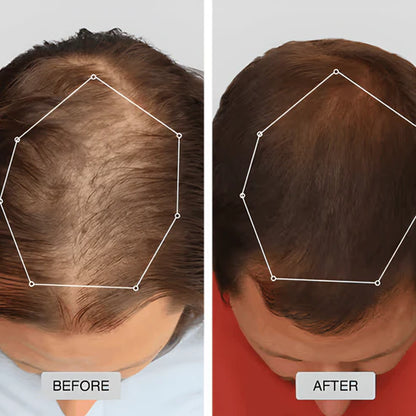 Red Light Cap for Hair Regrowth