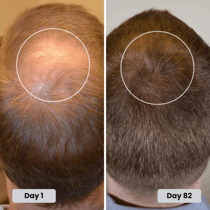 Red Light Cap for Hair Regrowth